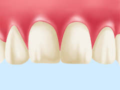 STEP01：歯の色の確認