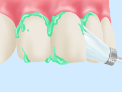 STEP02：歯面清掃