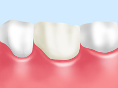 クラウン（全部を被せるもの）