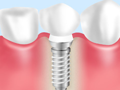 インプラントとは？