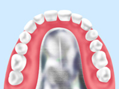 金属床義歯
