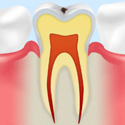 C0：ごく初期のむし歯