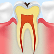 C1：エナメル質のむし歯