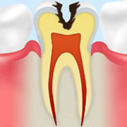 C2：象牙質のむし歯