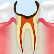 C3：神経まで達したむし歯