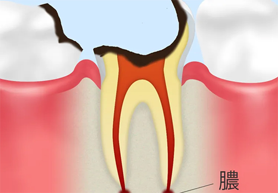 C4：歯根まで達したむし歯
